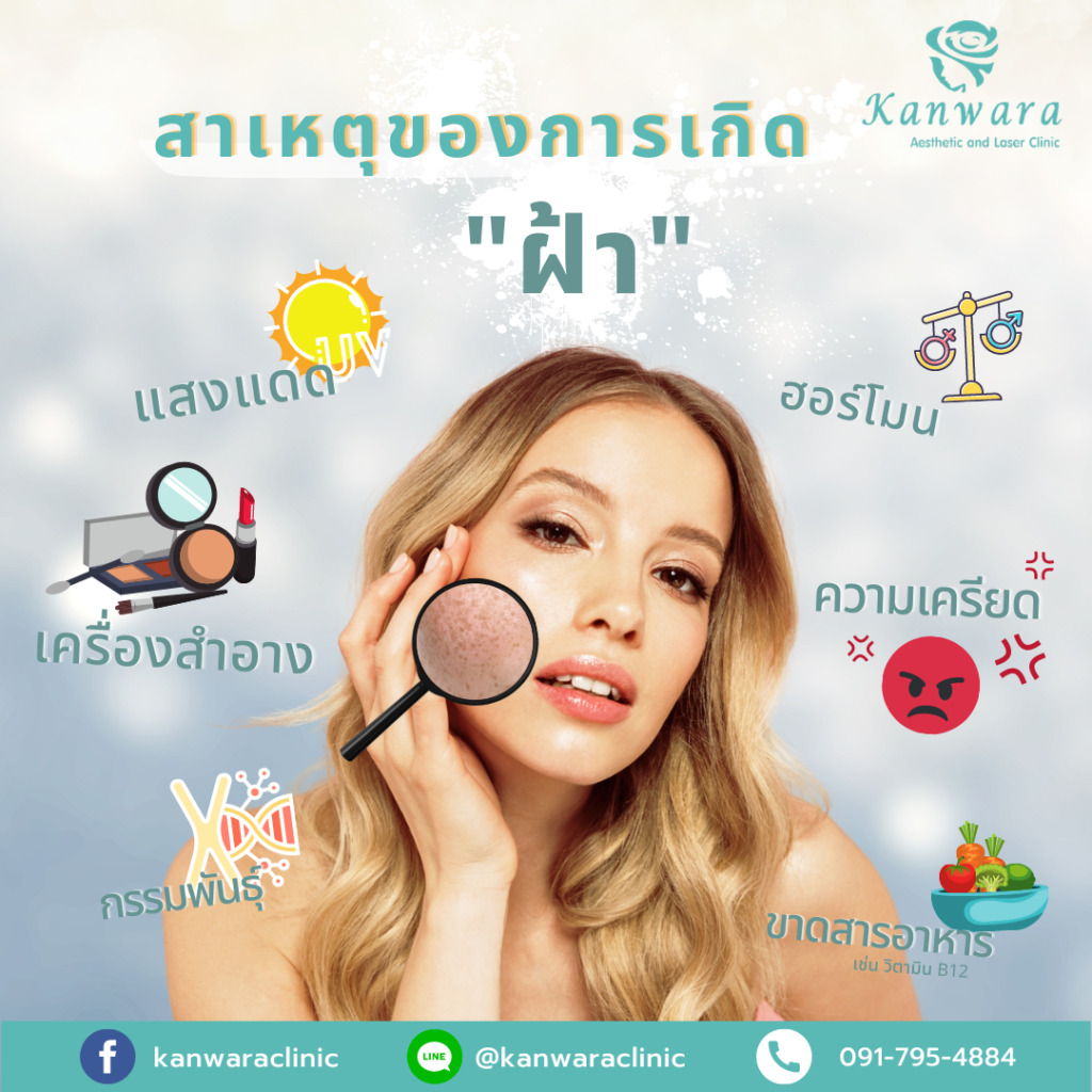 สาเหตุของการเกิดฝ้า