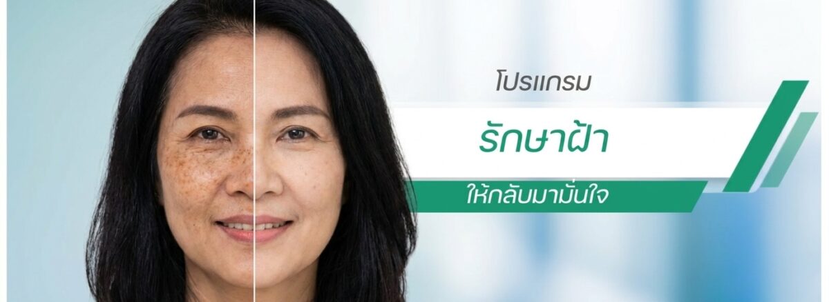 รักษาฝ้า กระ