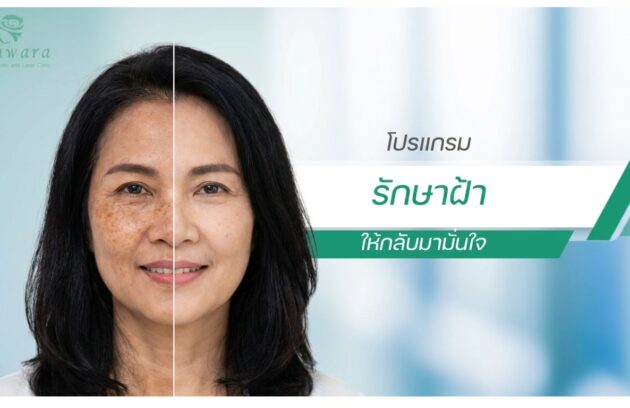 รักษาฝ้า กระ