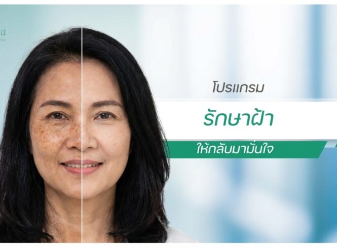 รักษาฝ้า กระ