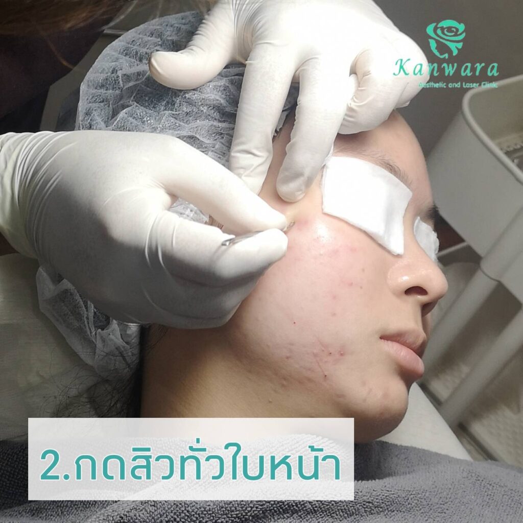 ขั้นตอนการกดสิวทั่วใบหน้า