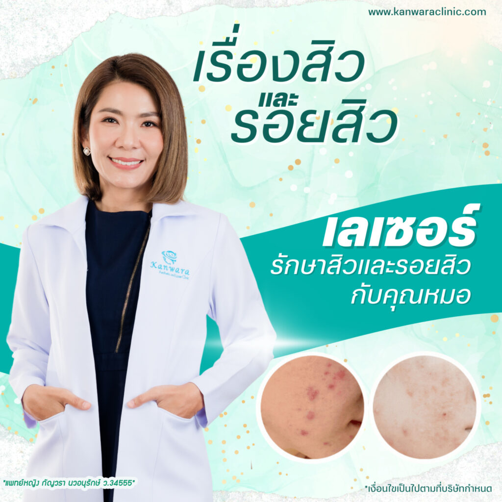 เลเซอร์รักษารอยสิวและรอยสิว กับคุณหมอ