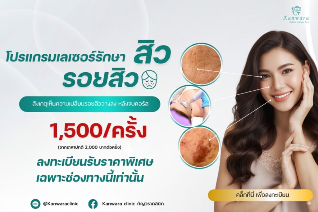 โปรแกรมรักษาสิว-รอยสิว-ด้วยเลเซอร์-1500
