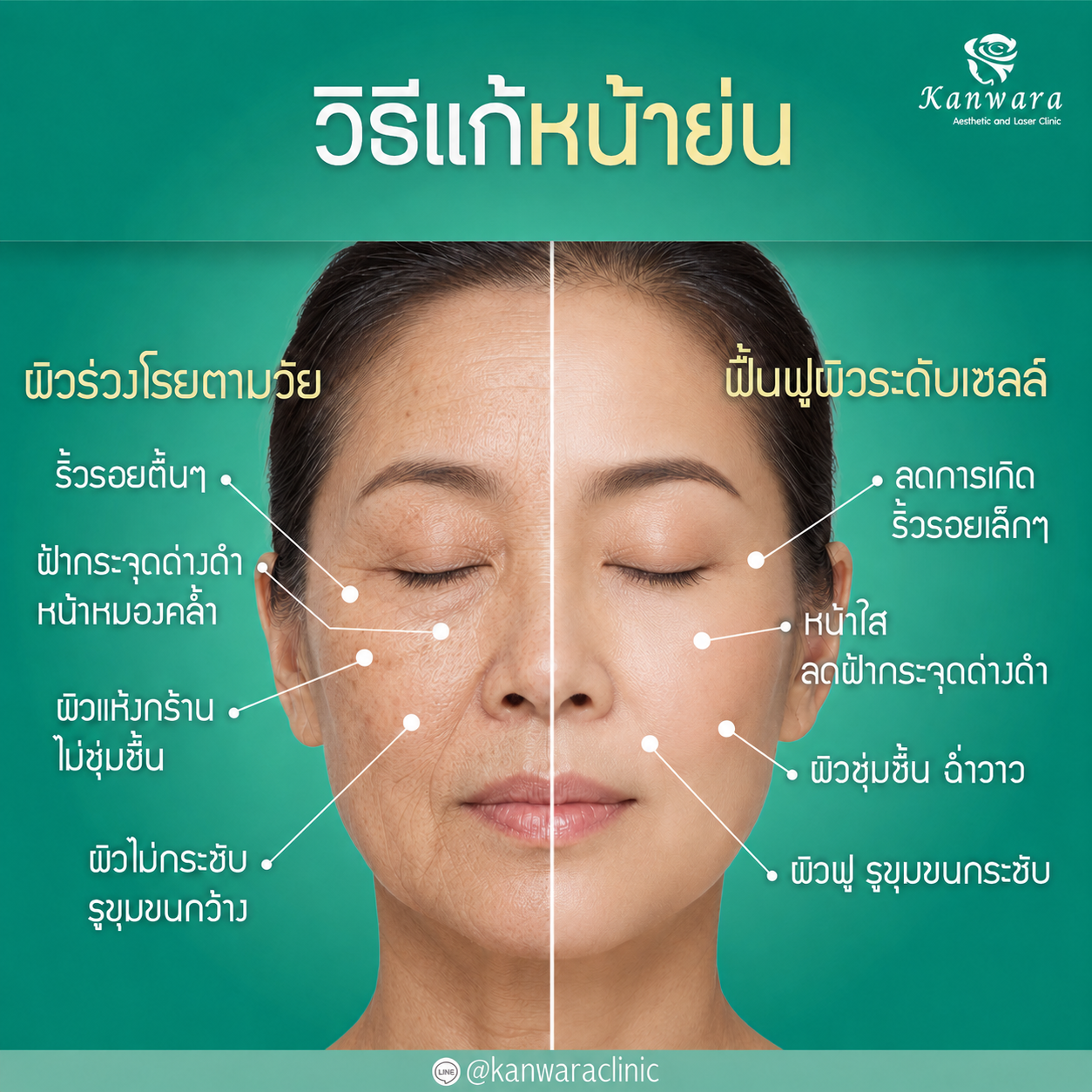 แก้หน้าย่น