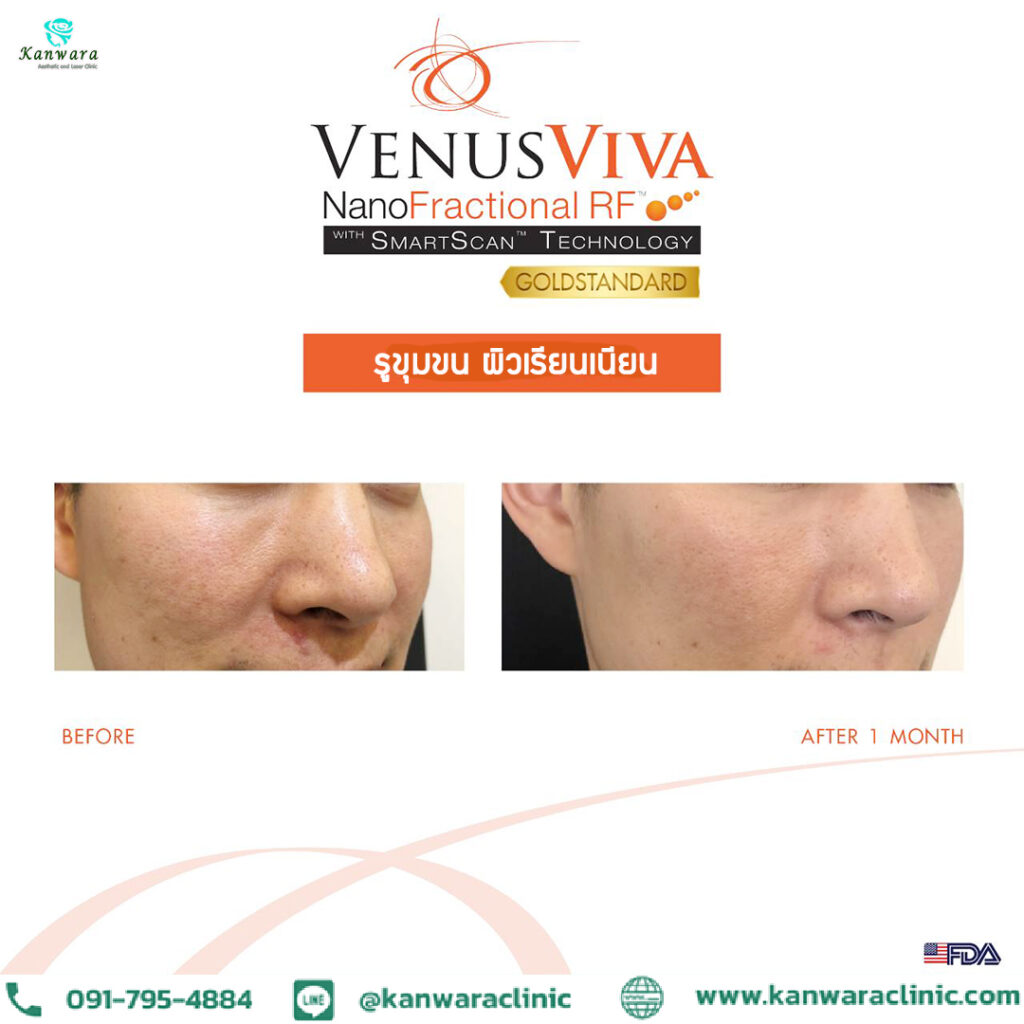 รีวิวเลเซอร์หลุมสิว