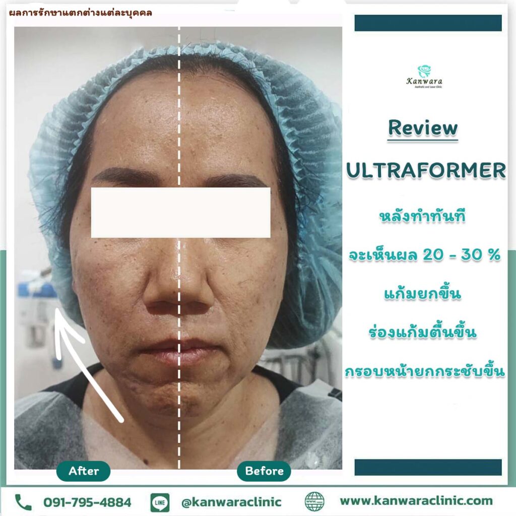 ultraformer review