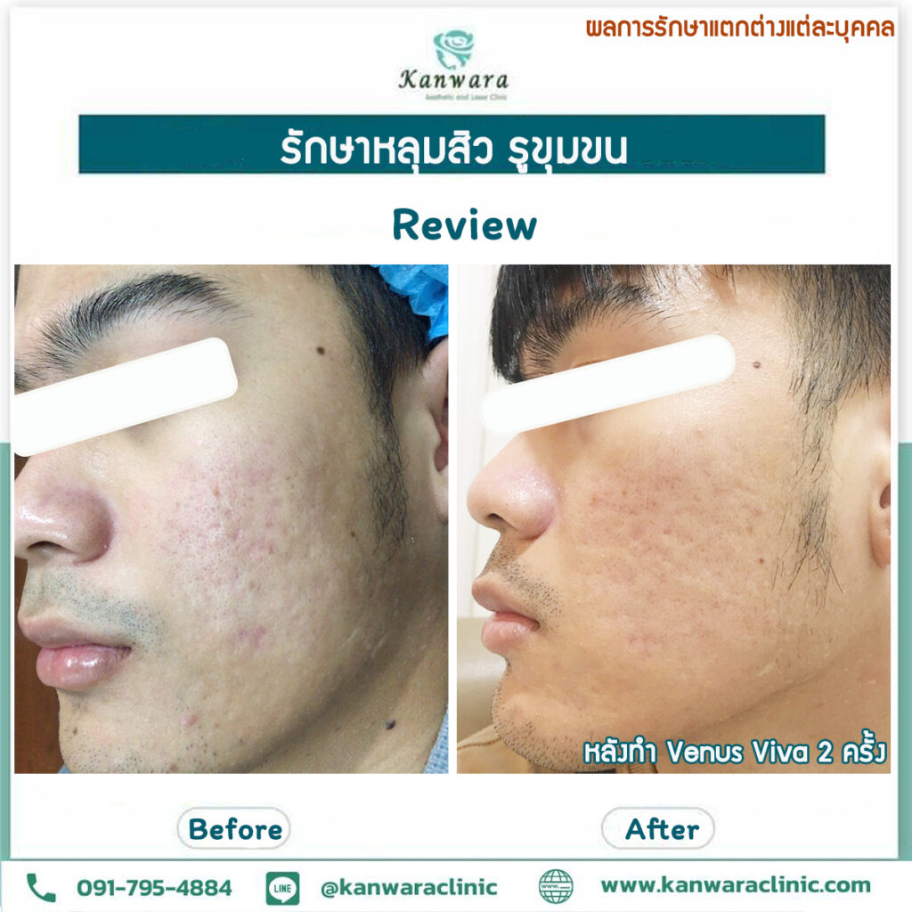 รีวิว รักษาหลุมสิว กัญวราคลินิก