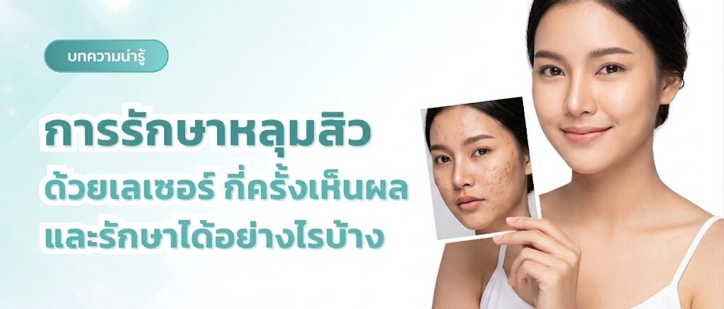 การรักษาหลุมสิวด้วยเลเซอร์-กี่ครั้งเห็นผล-และรักษาได้อย่างไรบ้าง