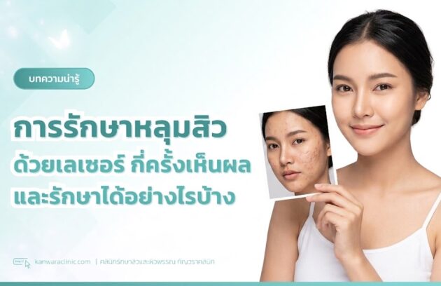 การรักษาหลุมสิวด้วยเลเซอร์-กี่ครั้งเห็นผล-และรักษาได้อย่างไรบ้าง