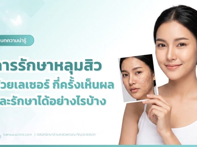 การรักษาหลุมสิวด้วยเลเซอร์-กี่ครั้งเห็นผล-และรักษาได้อย่างไรบ้าง