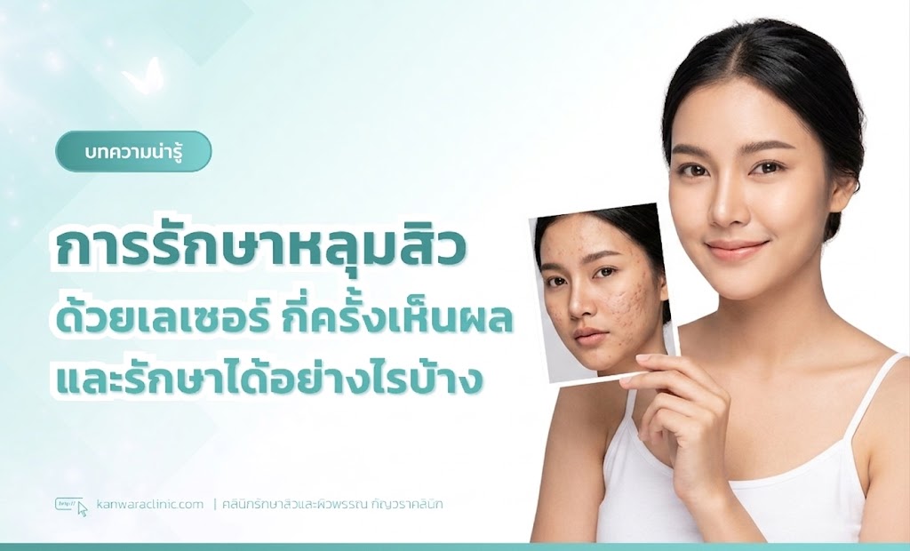 การรักษาหลุมสิวด้วยเลเซอร์-กี่ครั้งเห็นผล-และรักษาได้อย่างไรบ้าง