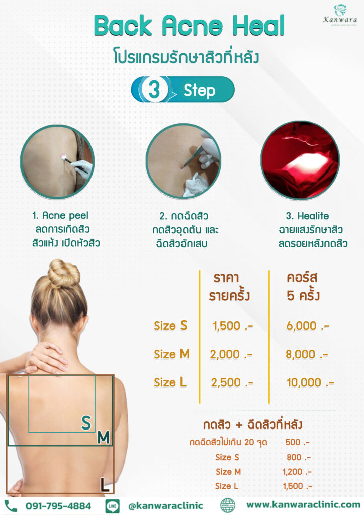 รักษาสิวหลังด่วน back acne heal ขั้นตอนราคา ห้องหมอ อัพเดต