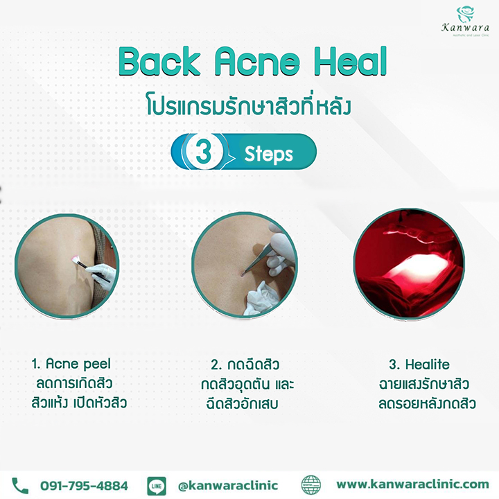 ขั้นตอน รักษาสิวหลัง เร่งด่วน