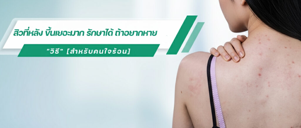 รักษาสิวที่หลัง เร่งด่วน