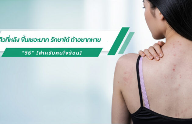 รักษาสิวที่หลัง เร่งด่วน