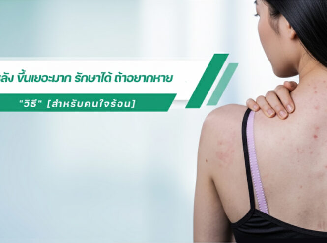 รักษาสิวที่หลัง เร่งด่วน
