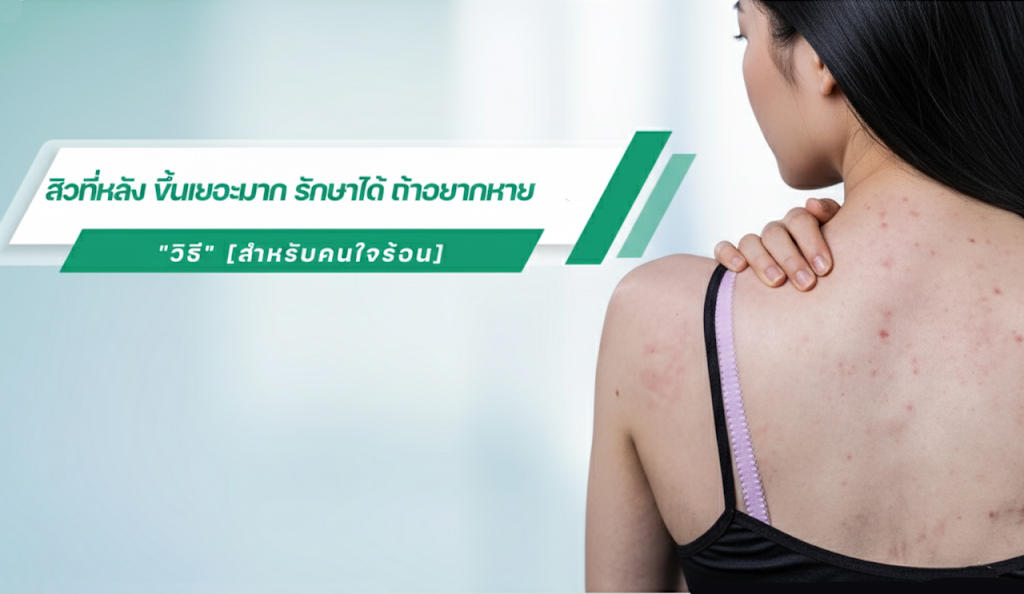 รักษาสิวที่หลัง เร่งด่วน