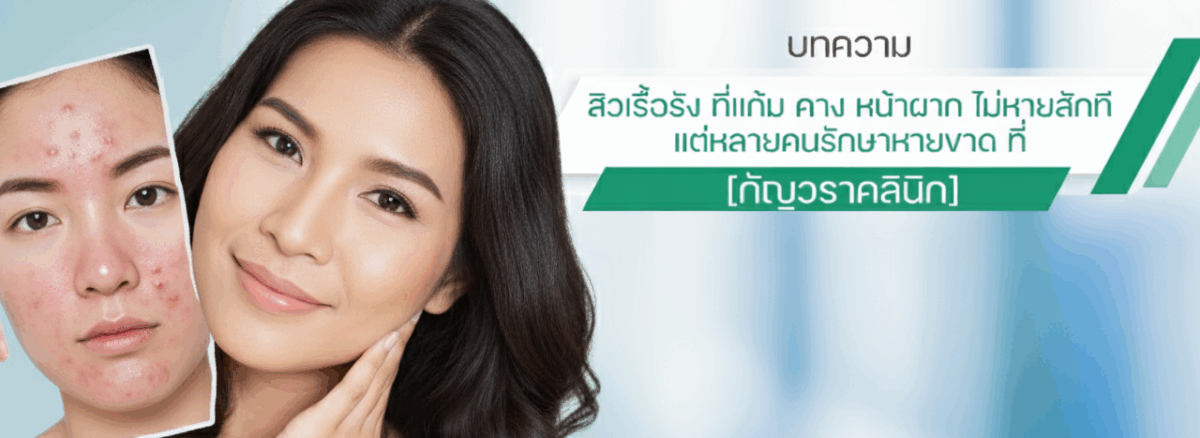 เป็นสิวที่หน้าผาก ไม่หายสักที
