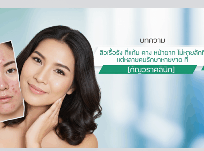 เป็นสิวที่หน้าผาก ไม่หายสักที