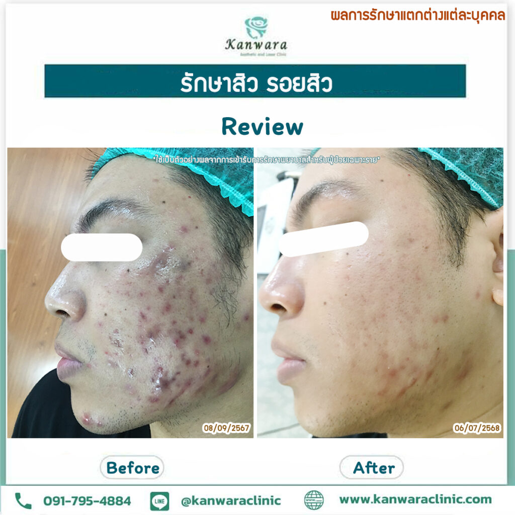 รีวิว รักษาสิว ที่ คลินิกรักษาสิว 1