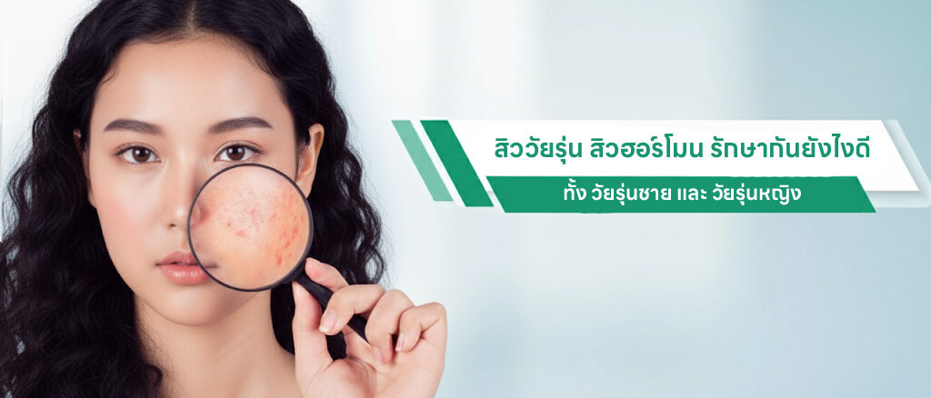 สิววัยรุ่น สิวฮอร์โมน รักษากันยังไงดี ทั้ง วัยรุ่นชาย และ วัยรุ่นหญิง