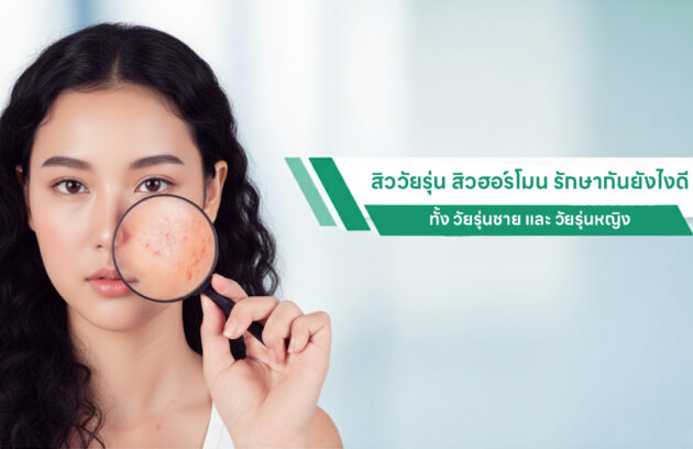 สิววัยรุ่น สิวฮอร์โมน รักษากันยังไงดี ทั้ง วัยรุ่นชาย และ วัยรุ่นหญิง