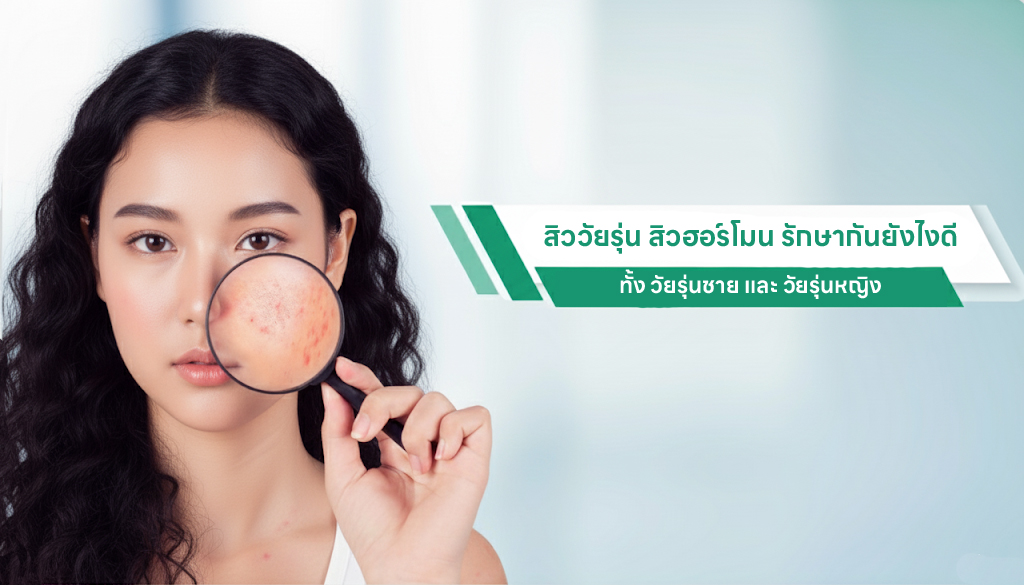 สิววัยรุ่น สิวฮอร์โมน รักษากันยังไงดี ทั้ง วัยรุ่นชาย และ วัยรุ่นหญิง