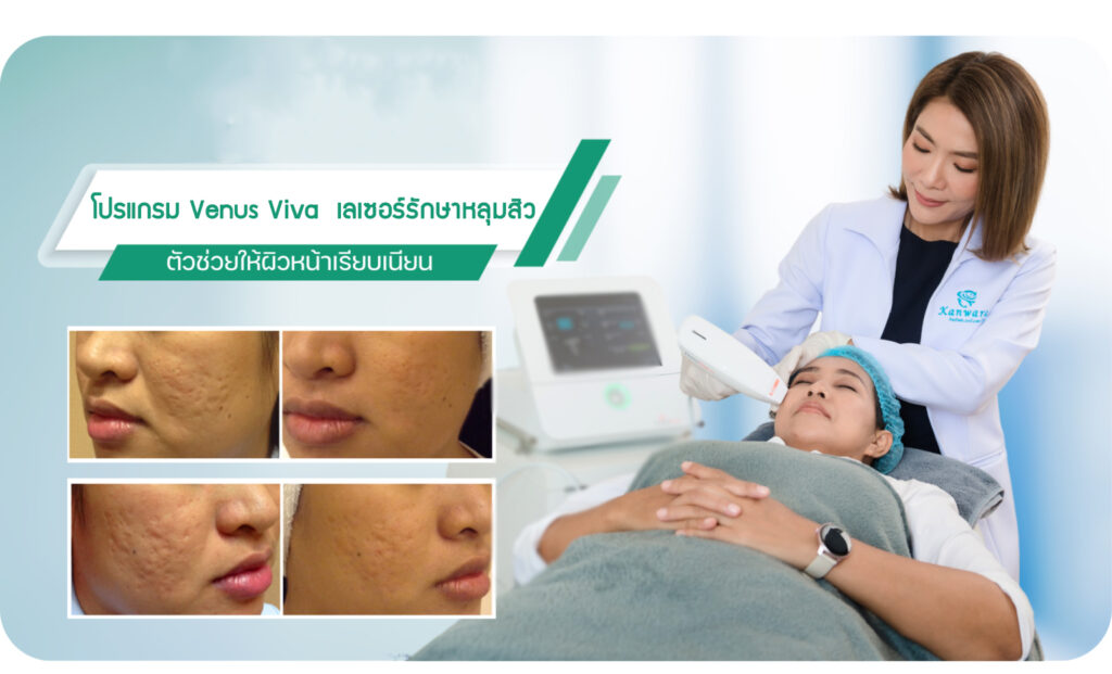 เลเซอร์หลุมสิว-ด้วย-Venus-เลเซอร์รักษาหลุมสิว-ผิวเรียบเนียนที่สุด