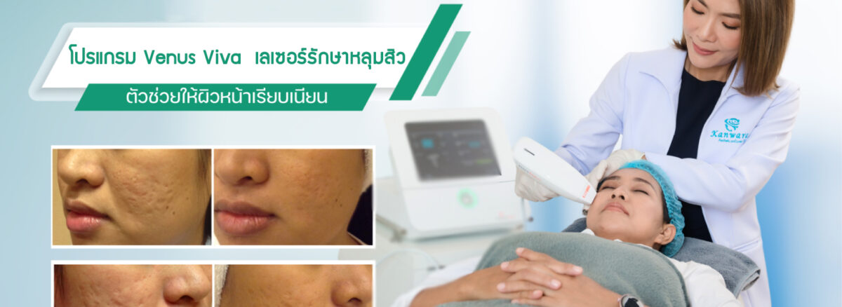 เลเซอร์หลุมสิว-ด้วย-Venus-เลเซอร์รักษาหลุมสิว-ผิวเรียบเนียนที่สุด