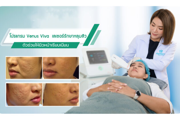 เลเซอร์หลุมสิว-ด้วย-Venus-เลเซอร์รักษาหลุมสิว-ผิวเรียบเนียนที่สุด