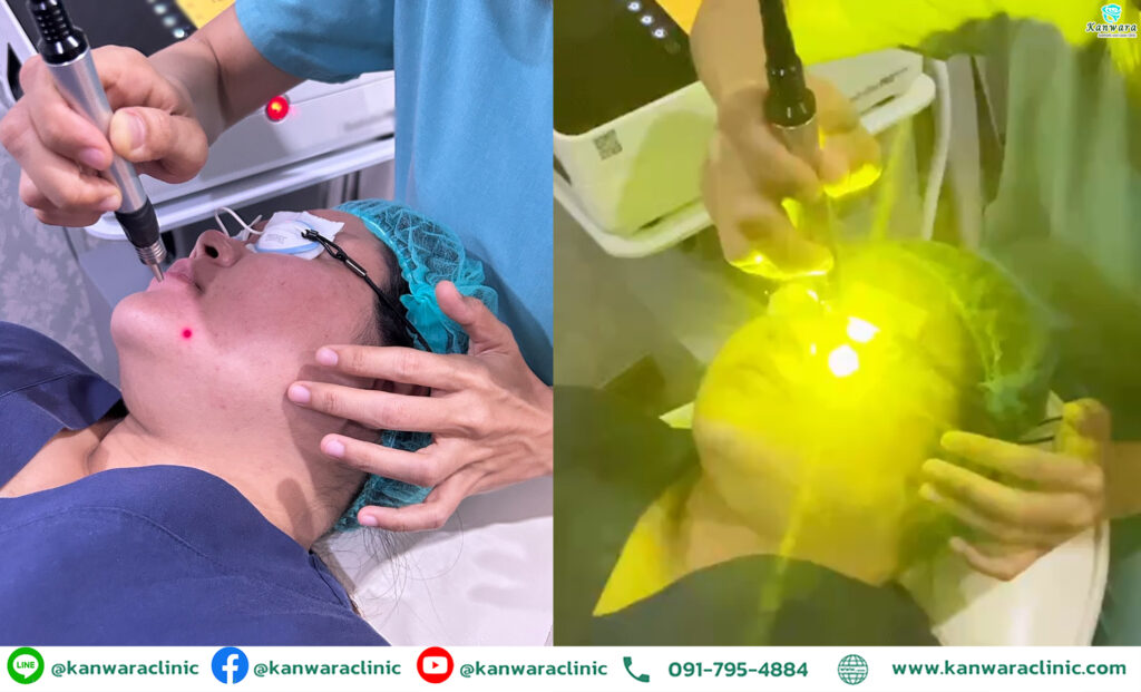 Pro Yellow laser รักษารอยสิวเห็นผล