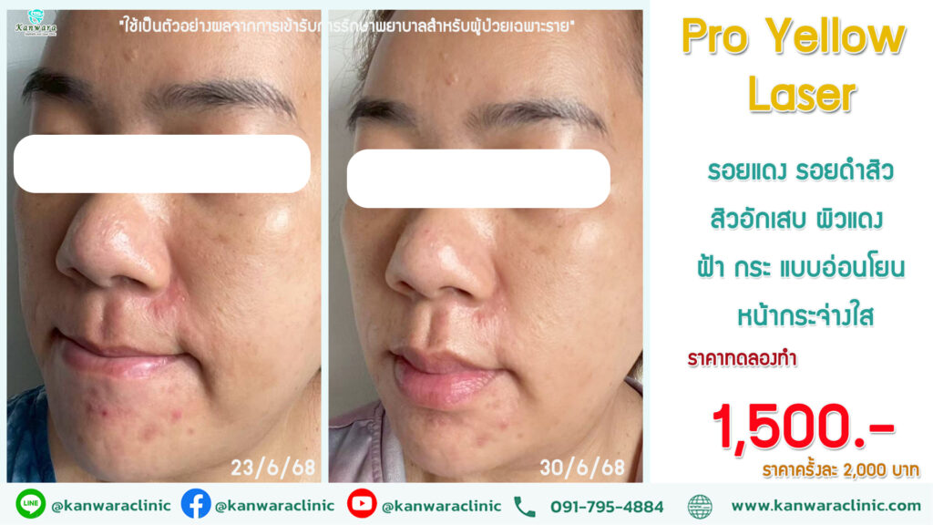 Pro Yellow Laser รีวิว