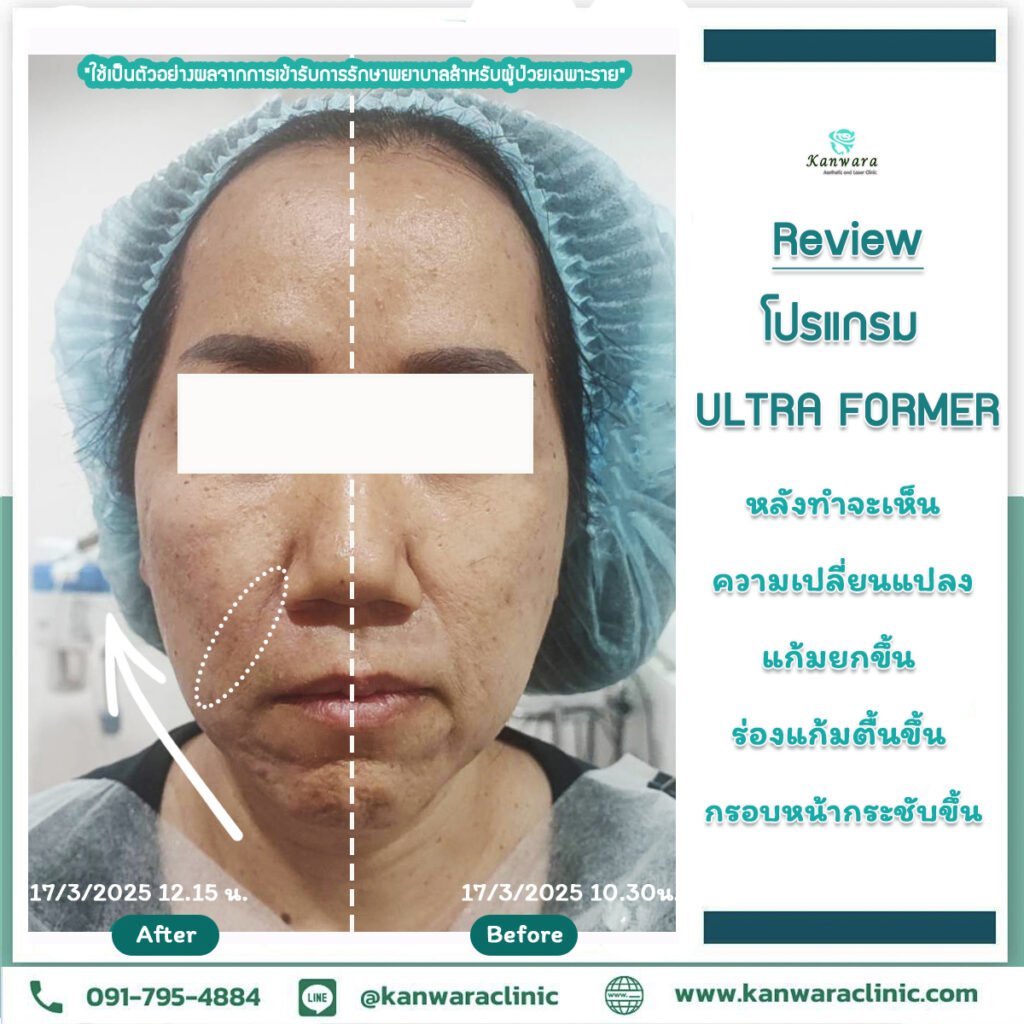 รีวิว Ultraformer ต่าย