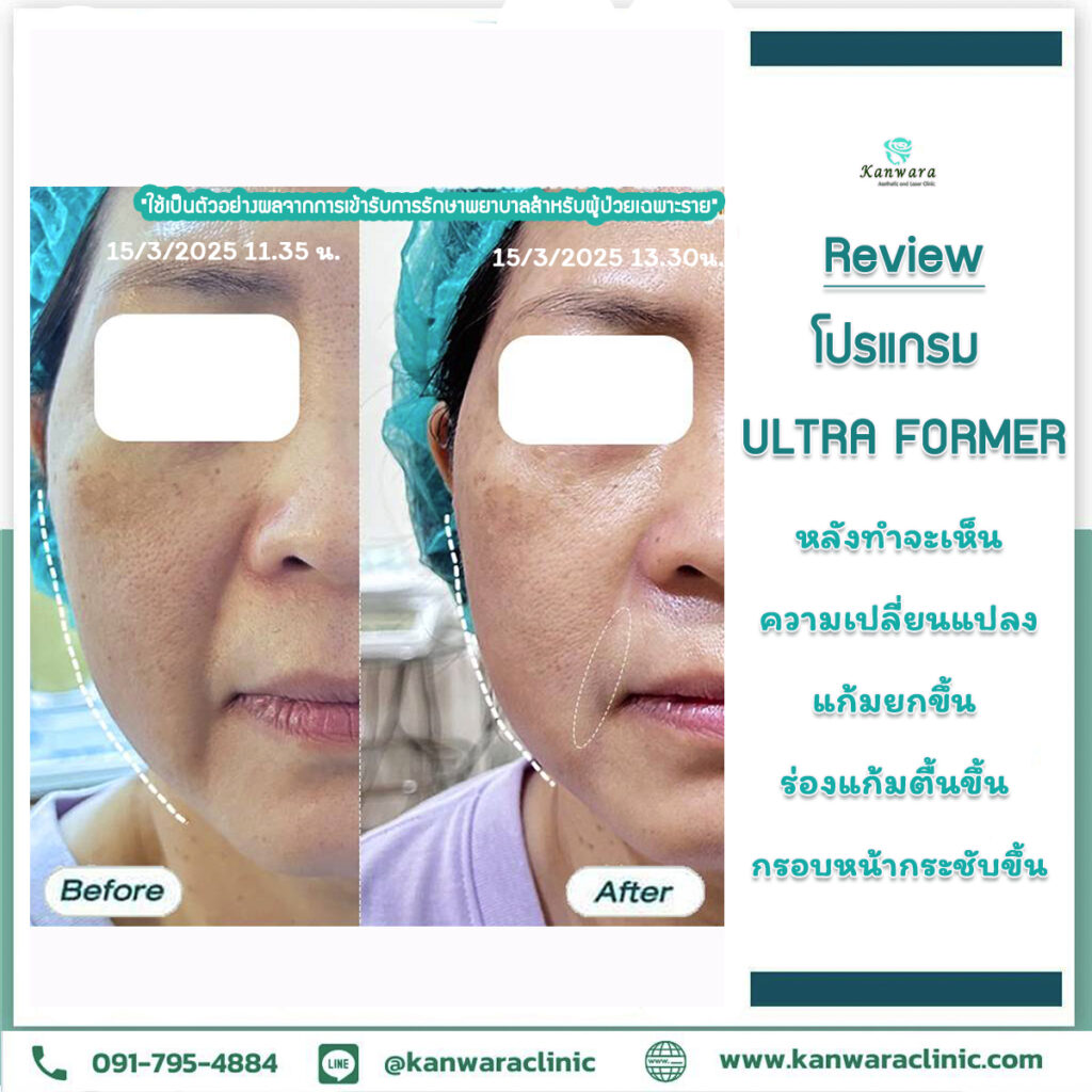 Ultraformer รีวิว แตน