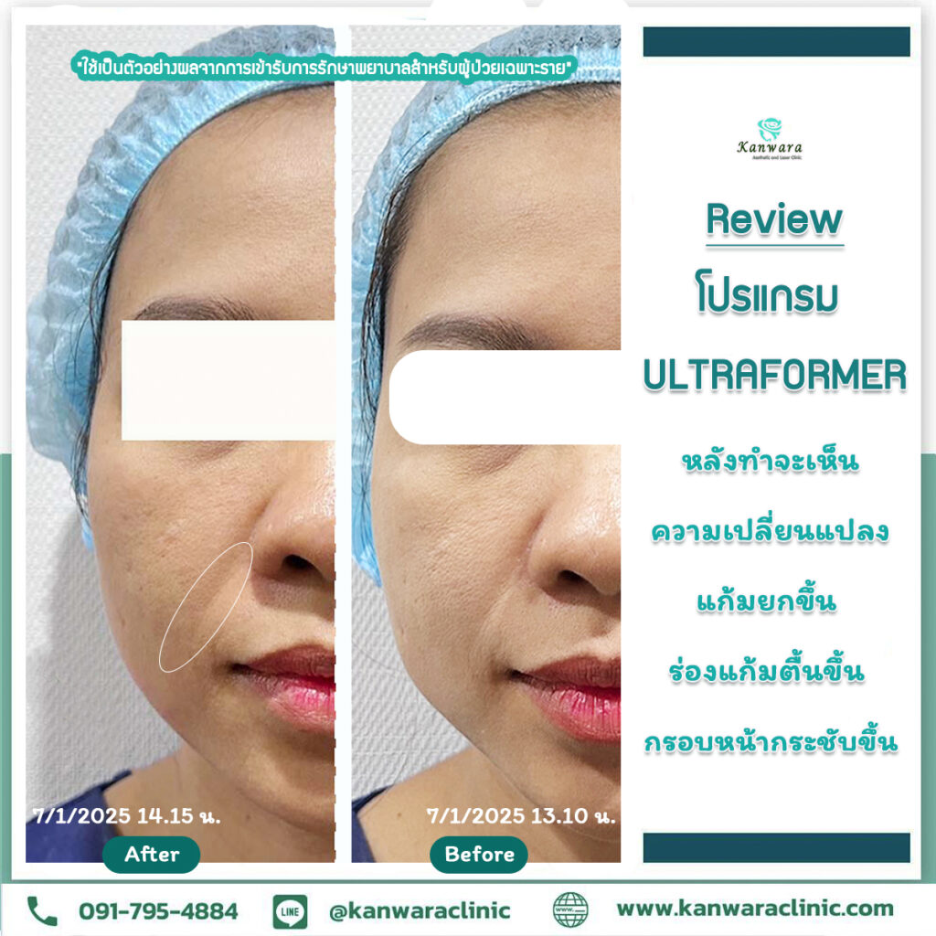 รีวิว Ultraformer แอ๋ว