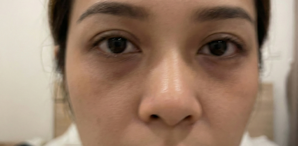 ใต้ตาคล้ำ ใต้ตาดำ