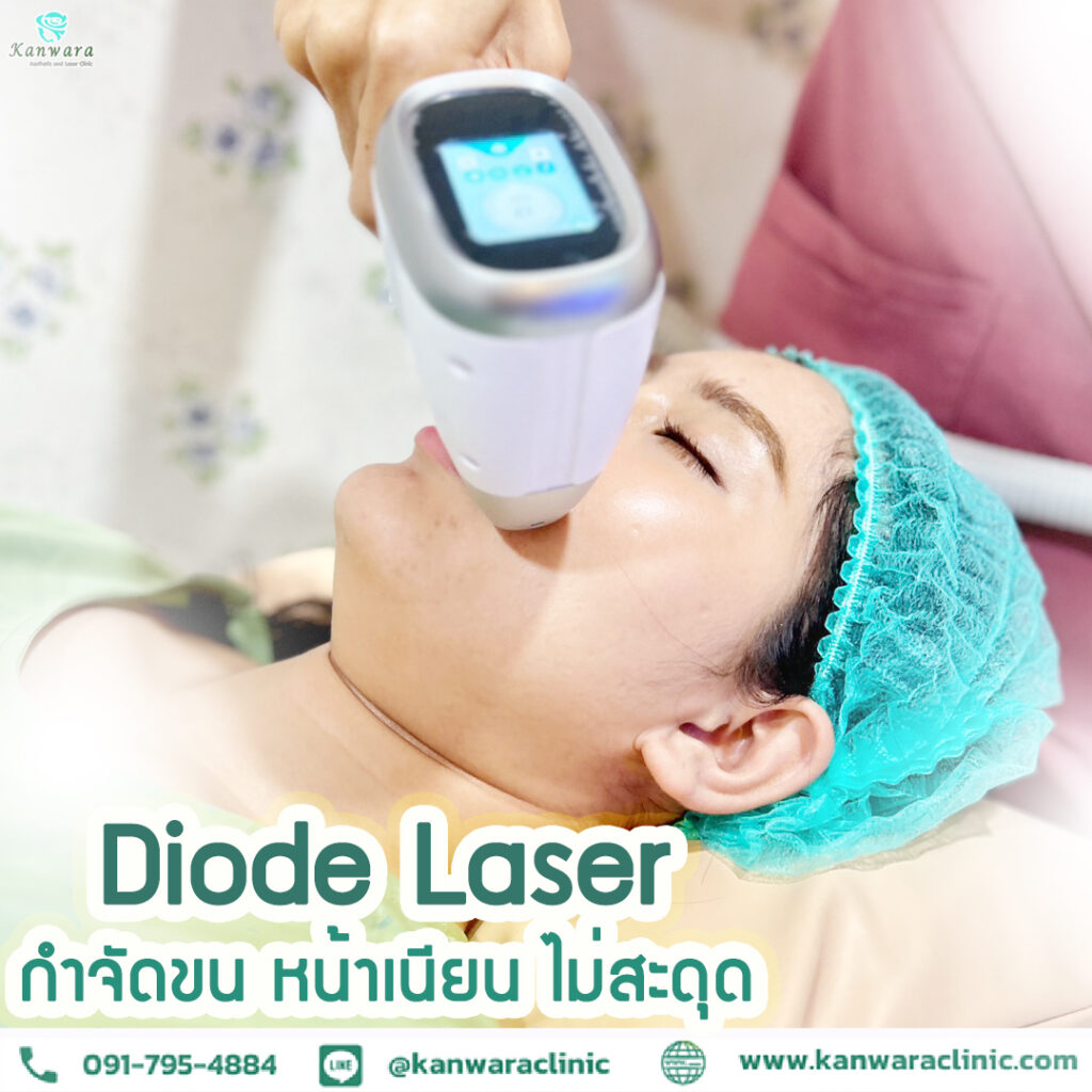 ไดโอดเลเซอร์ เลเซอร์ขน