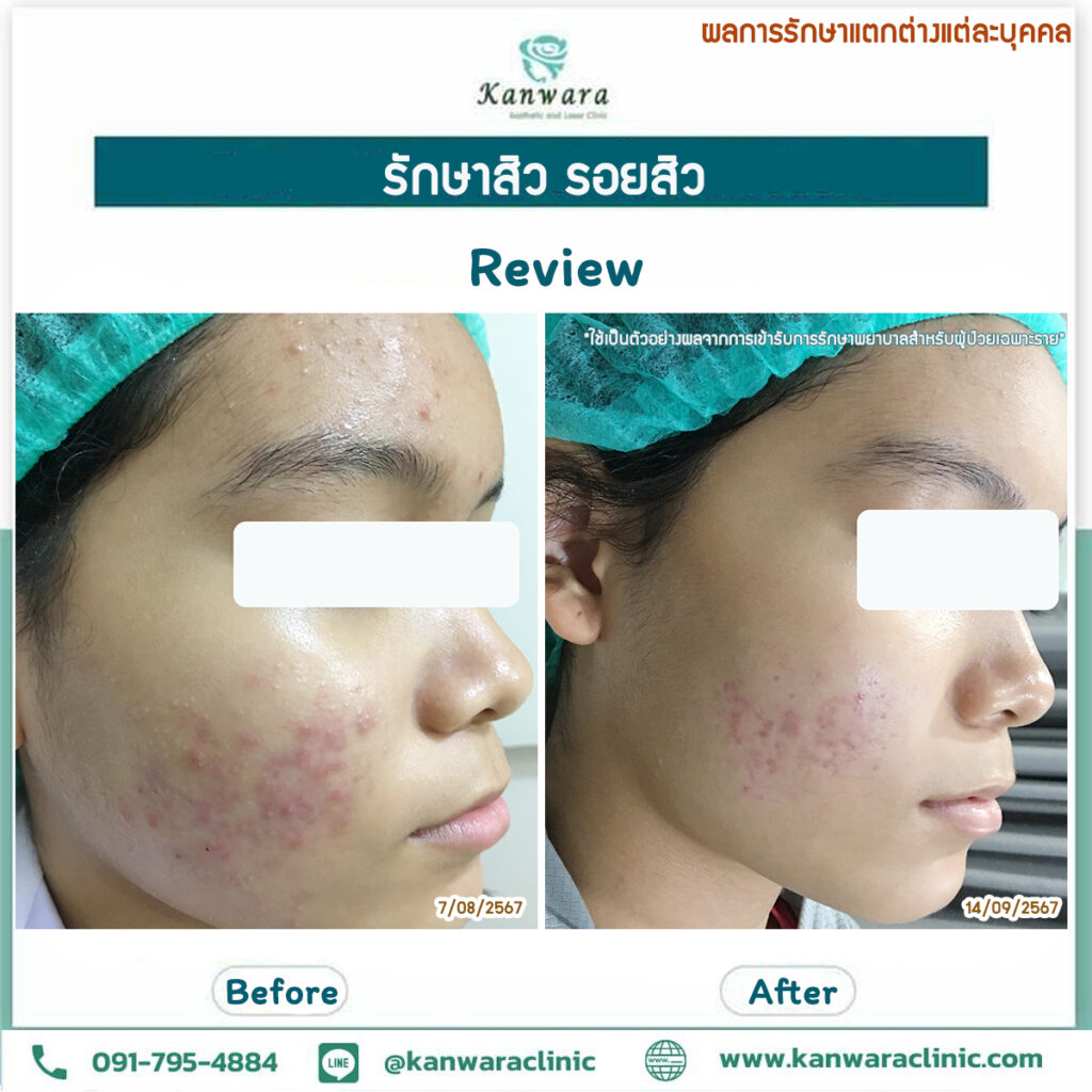 รักษาสิว รอยสิว หายขาด รีวิว