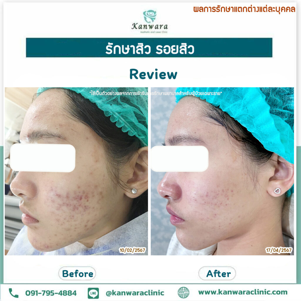 รักษาสิว รอยสิว หายขาด รีวิว