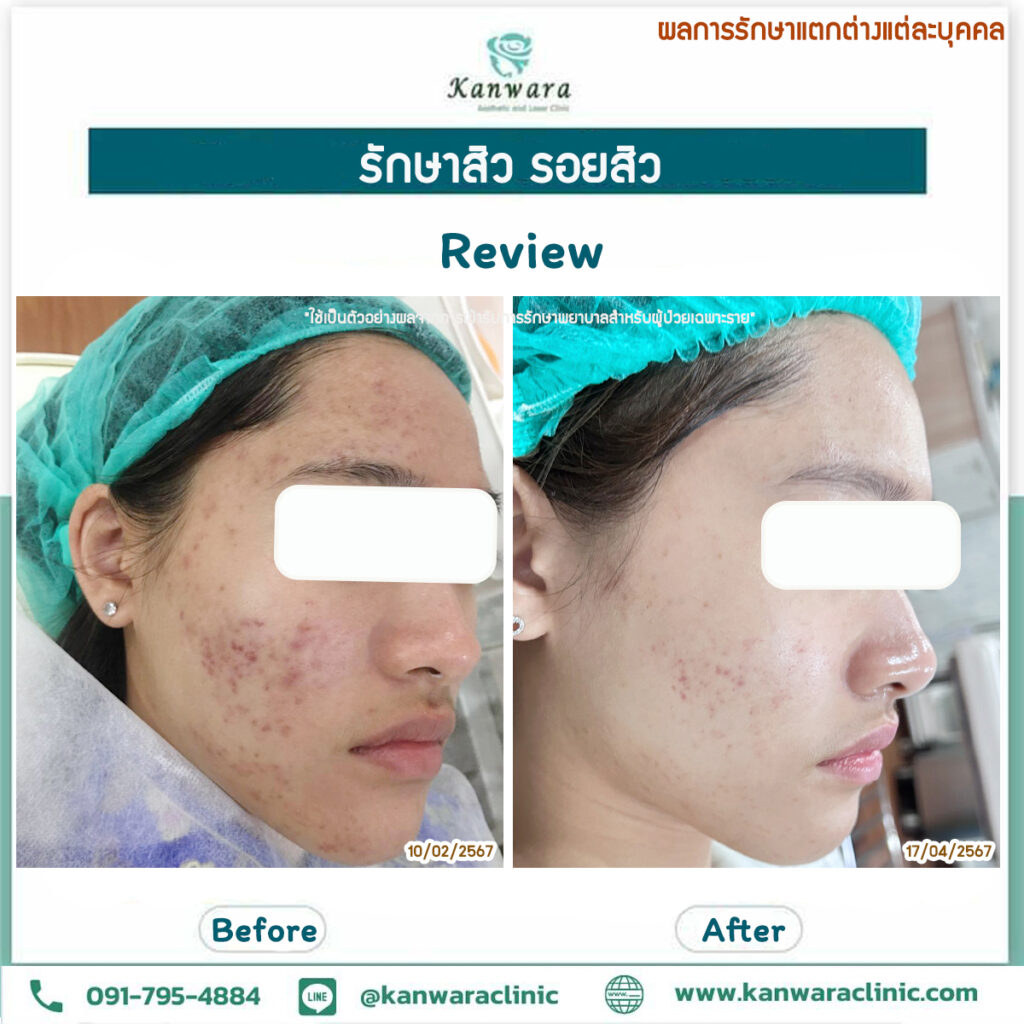 รักษาสิว รอยสิว หายขาด รีวิว