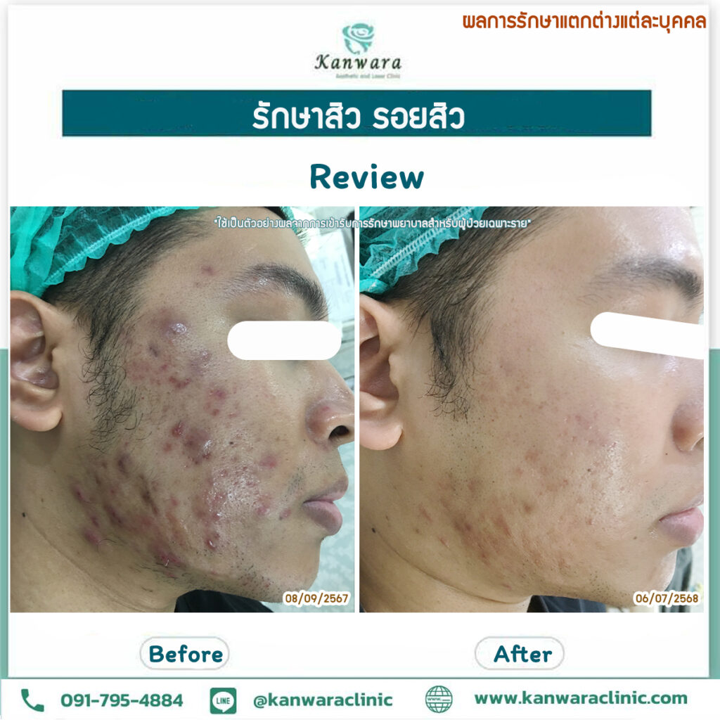 รักษาสิว รอยสิว หายขาด รีวิว