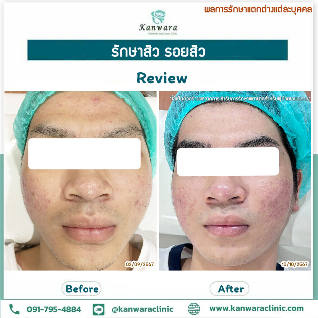 รักษาสิว รอยสิว หายขาด รีวิว