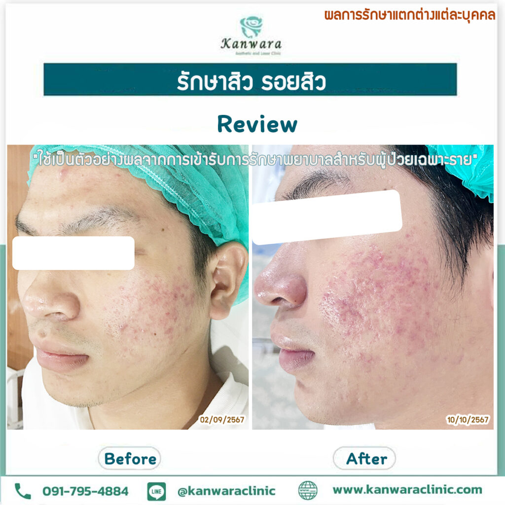 รักษาสิว รอยสิว หายขาด รีวิว