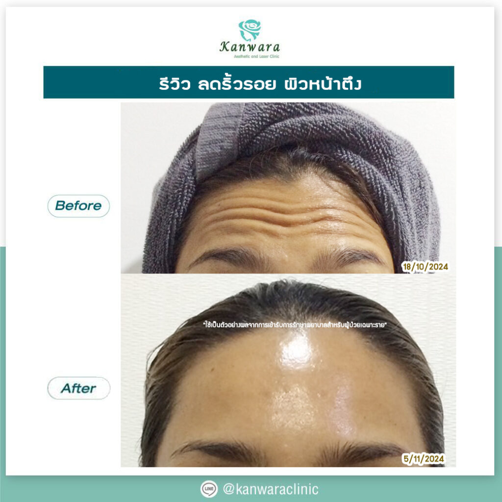 รีวิว botox