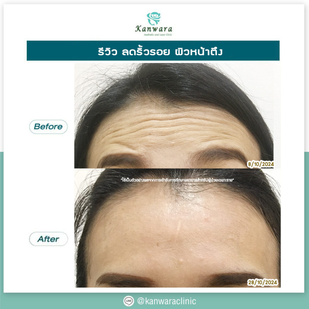 รีวิว botox