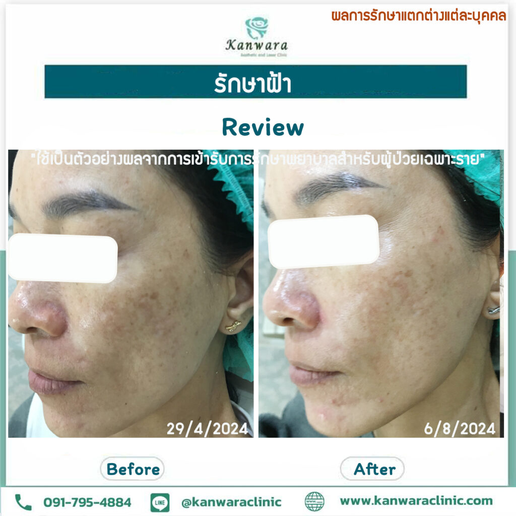 กระเนื้อ