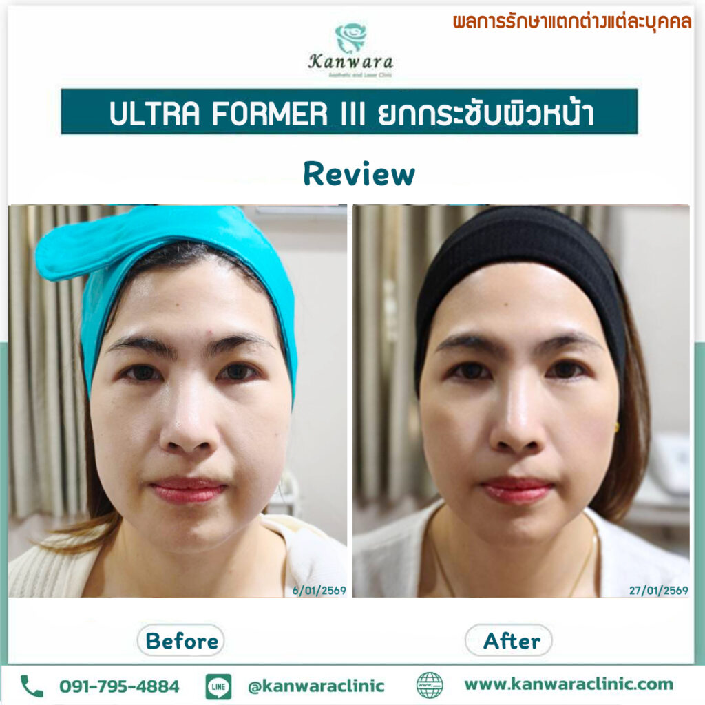 หน้าเรียว หน้าตึง หน้าเด็กลง ทันที ไม่ศัล