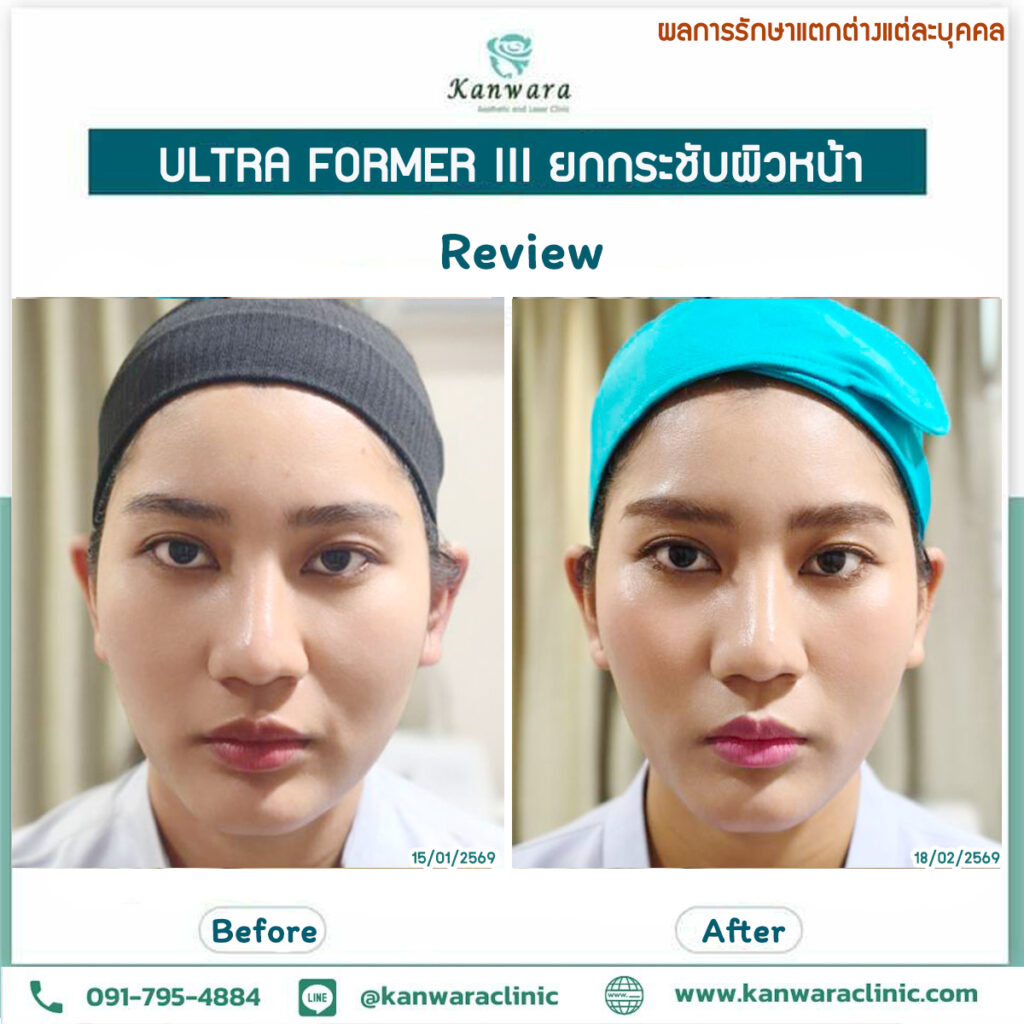 รี วิว หน้ายกกระชับ ทันที หน้าเด็ก หน้าเรียว เห็นผลทันที