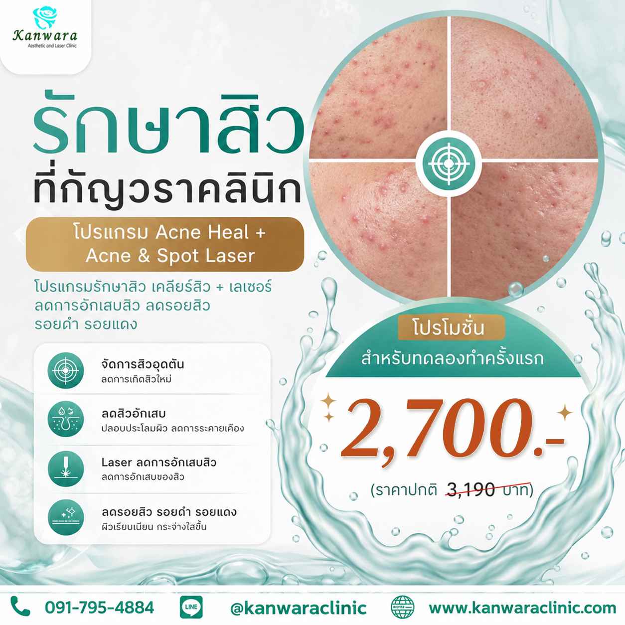 รักษา สิว ที่คลินิก ครั้งแรก ราคา พิเศษ