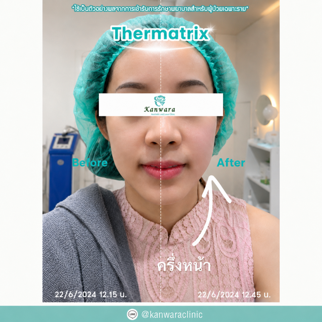 แก้หน้ามีริ้วรอย Thermatrix ก่อนหลัง หมออุ้ม